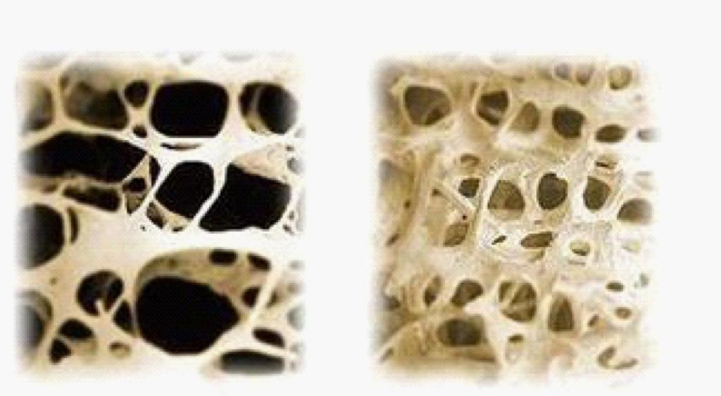 normaal bot en bot met osteoporose